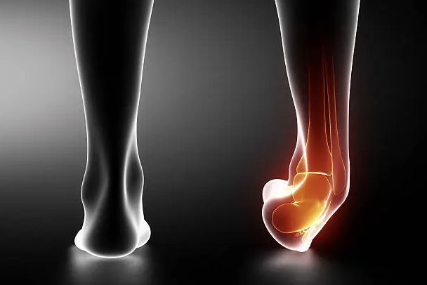 足関節捻挫を軽く見てませんか？