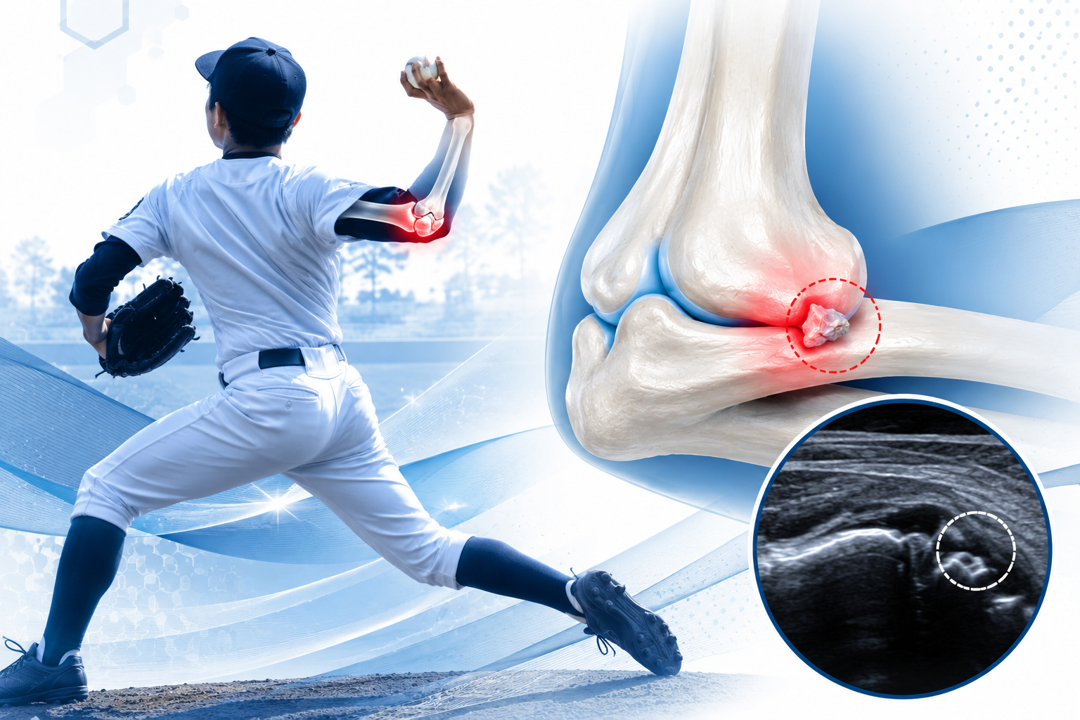 【野球肘】痛みがなくても要注意！OCD（上腕骨小頭離断性骨軟骨炎）とは？